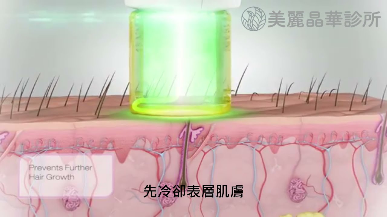 智慧型冷卻系統DCD_Gentlelase 亞歷山大紫翠玉雷射