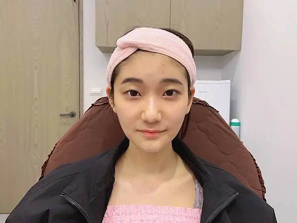 艾麗斯新聚雙旋乳酸治療前