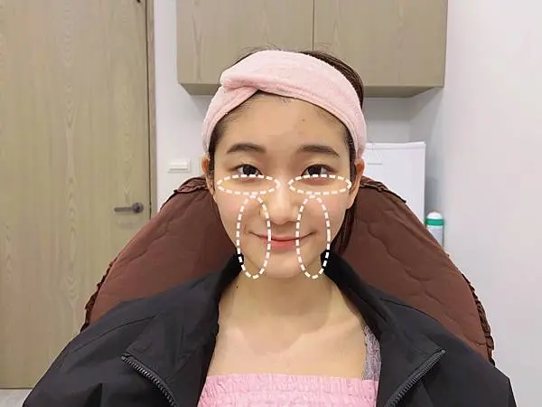 艾麗斯新聚雙旋乳酸治療前臉瘦眼凹淚溝明顯