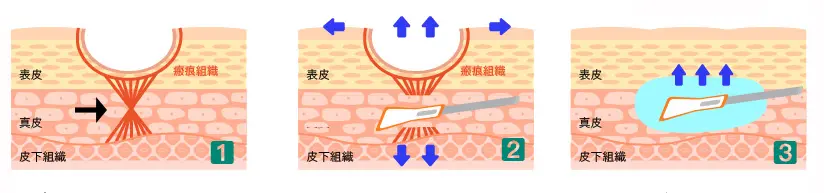 痘疤 產生的原因。為什麼 皮下剝離 有效