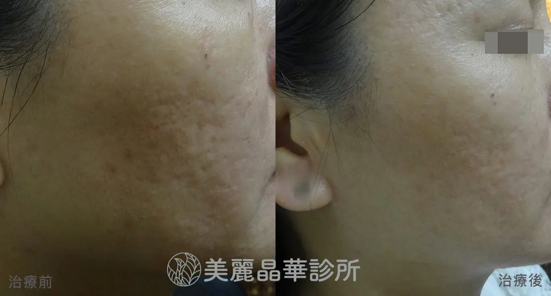 痘疤 凹洞 使用皮下剝離 美麗晶華治療範例分享1