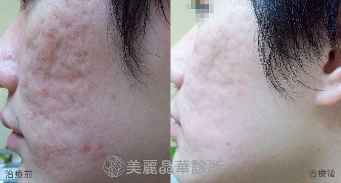 痘疤 凹洞 使用皮下剝離 美麗晶華治療範例分享4