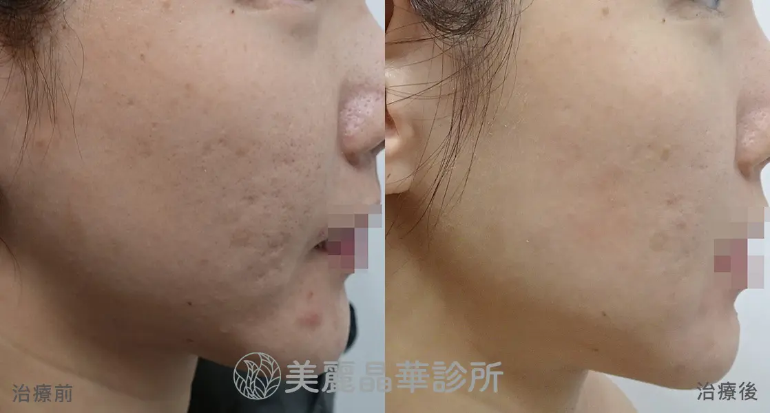 痘疤凹洞 使用皮下剝離 美麗晶華治療範例分享8
