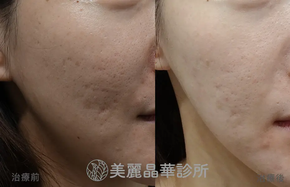 痘疤皮下剝離術範本