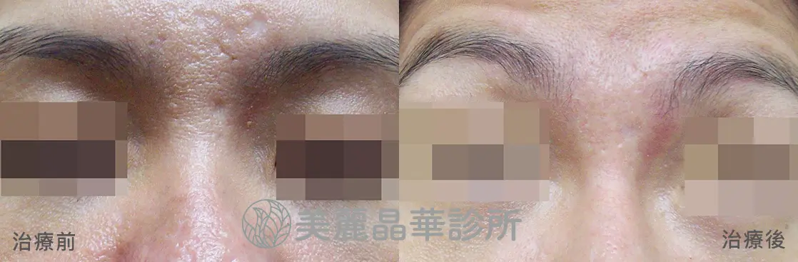 痘疤凹洞 使用皮下剝離 美麗晶華治療範例分享7