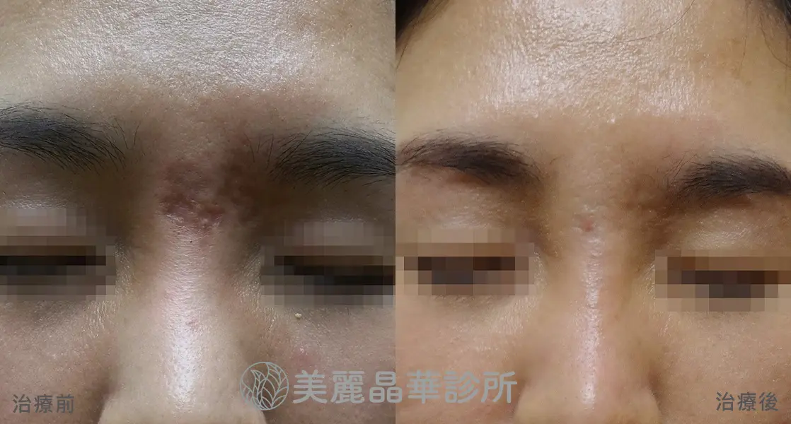 痘疤 凹洞 使用皮下剝離 美麗晶華治療範例分享3