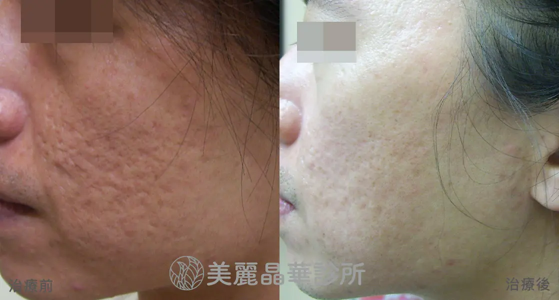 痘疤 凹洞 使用皮下剝離 美麗晶華治療範例分享2