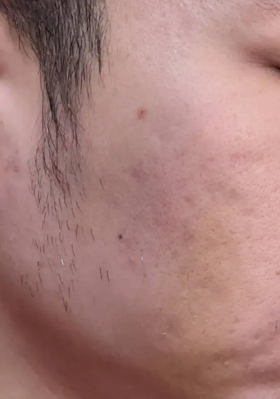 皮下剝離治療 痘疤 ，術後隔天照片