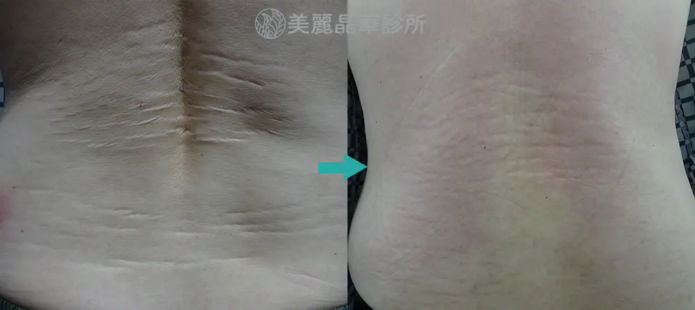 妊娠紋 生長紋肥胖紋治療案例分享