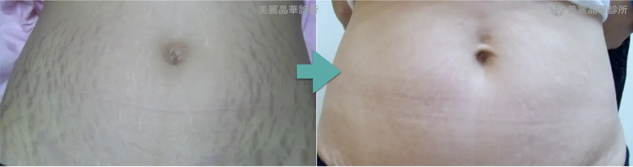 妊娠紋 生長紋肥胖紋治療案例分享1