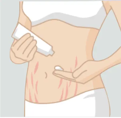 妊娠紋即使用了各式各樣的乳液乳霜，還是沒有效果