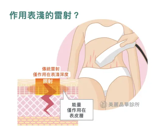 破除妊娠紋迷思，作用表淺的雷射或儀器