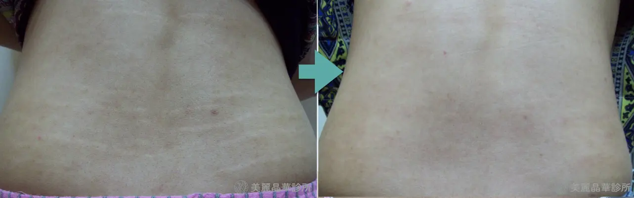 妊娠紋 生長紋肥胖紋治療案例分享 