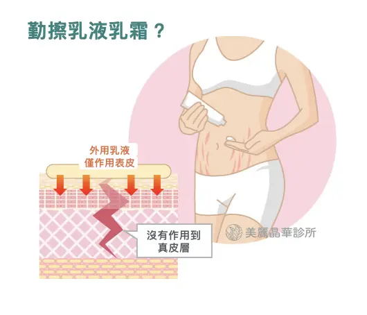 破除 妊娠紋 迷思，勤勞擦乳液或乳霜