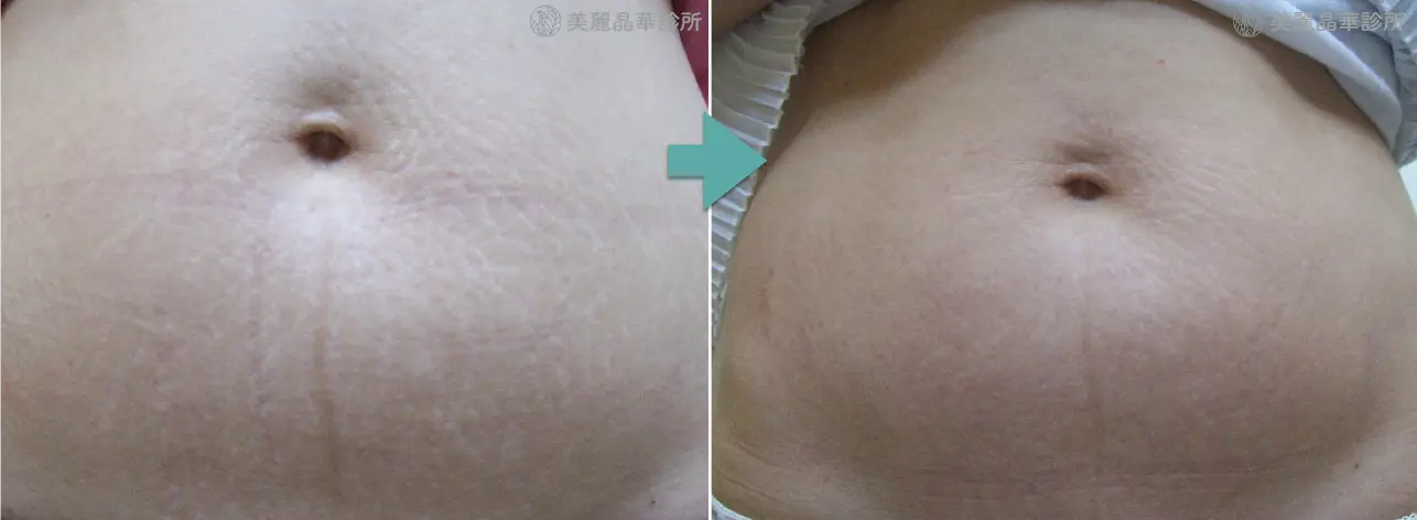 妊娠紋 生長紋肥胖紋治療案例分享2