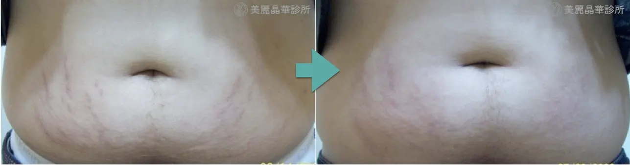 妊娠紋 生長紋肥胖紋治療案例分享4