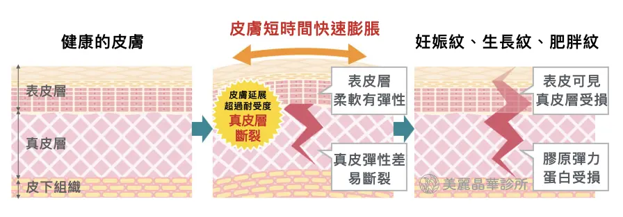 皮膚短時間快速膨脹，就會產生 妊娠紋