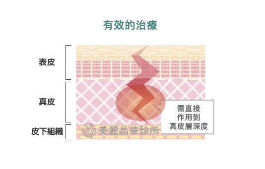 妊娠紋有效的治療在於需直接作用到真皮層深度