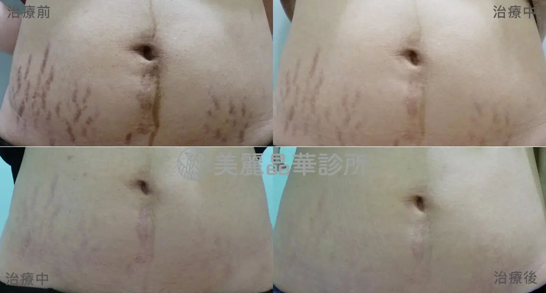 妊娠紋 生長紋肥胖紋治療案例分享 