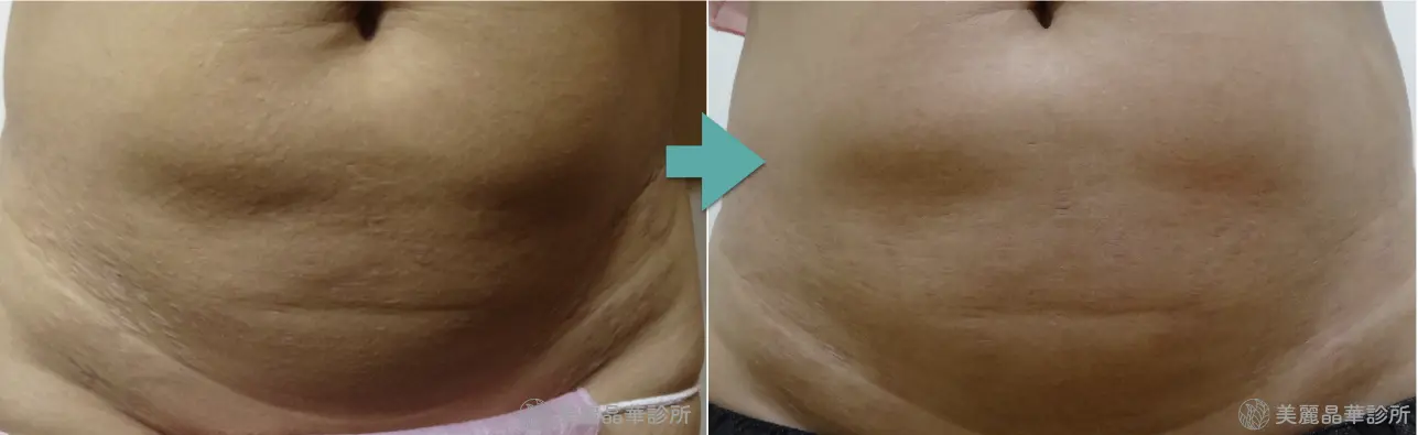 妊娠紋 生長紋肥胖紋治療案例分享5