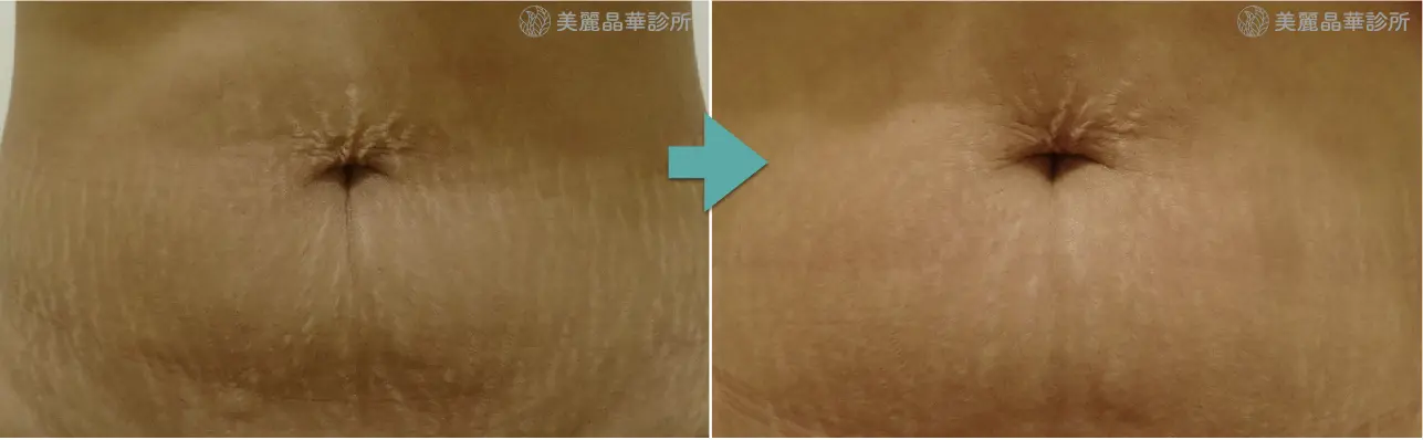 妊娠紋 生長紋肥胖紋治療案例分享3