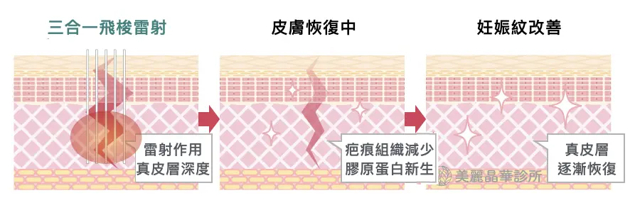 美麗晶華改善妊娠紋的關鍵 三合一飛梭雷射