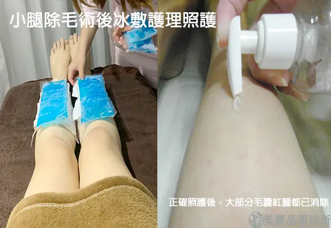 雷射除毛