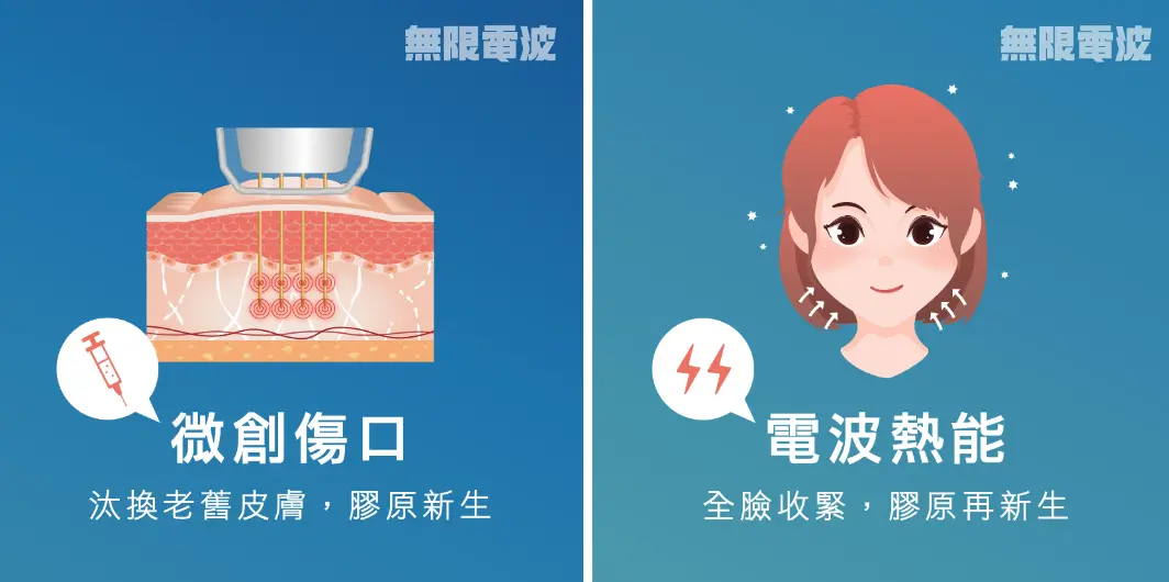 無限電波 potenza 術前術後效果