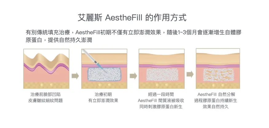 淚溝使用愛麗絲治療改善