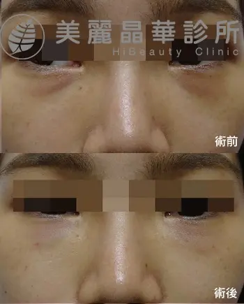 肌肉 淚溝 範例照片