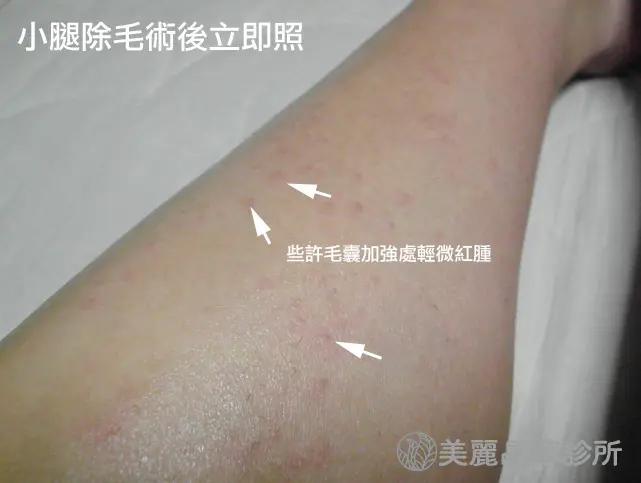 雷射除毛