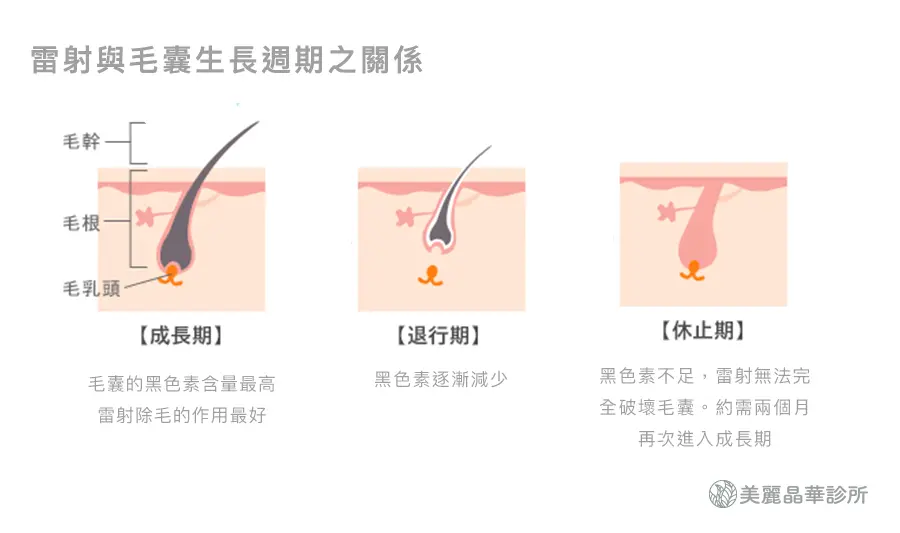 雷射除毛