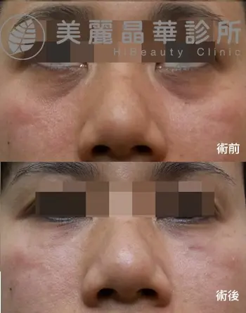韌帶型 淚溝 範例照片