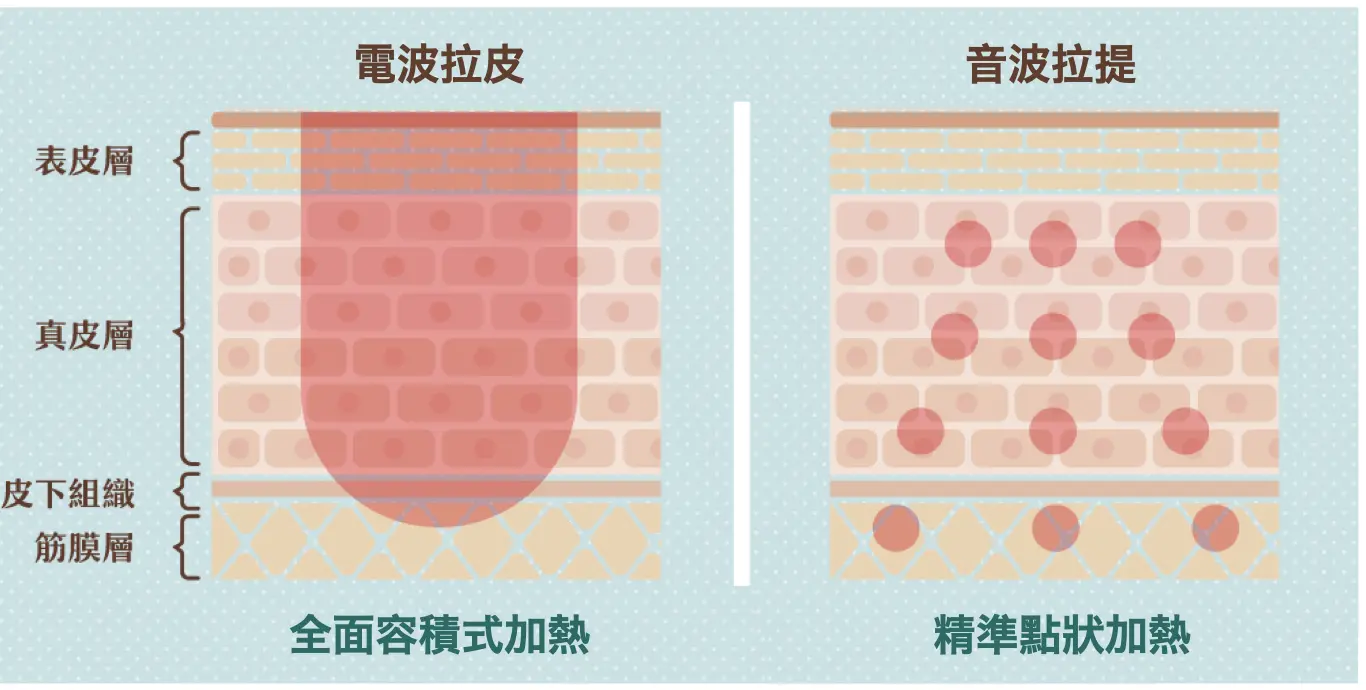 音波拉提 / 電波拉皮 不同的地方