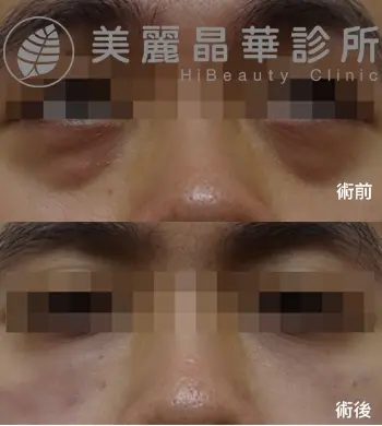 鬆弛型 淚溝 範例照片