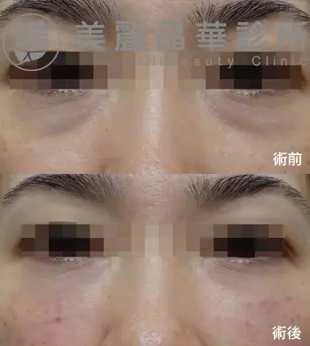 眼袋型 淚溝 範例照片