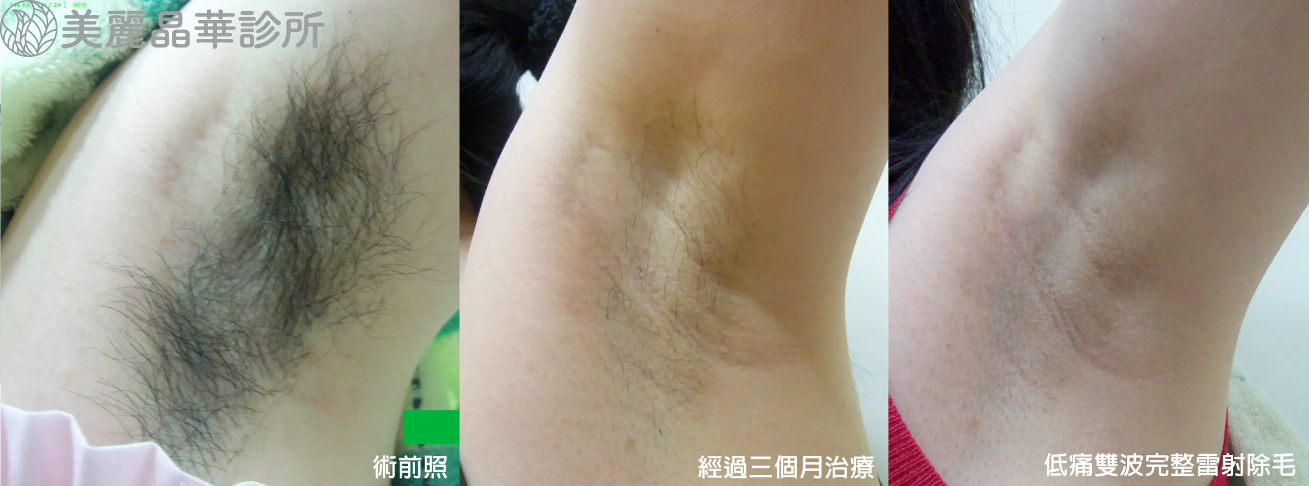 雷射除毛