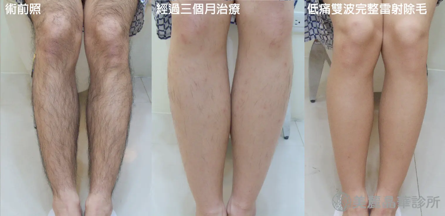 雷射除毛