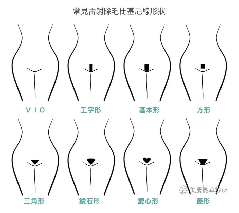 VIO 常見雷射除毛比基尼形狀