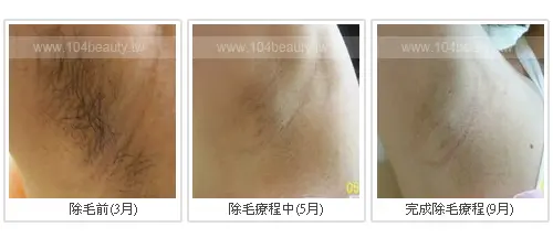 雷射除毛術前術後差異比較