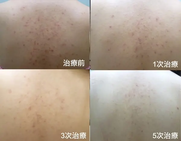 德國光纖粉餅雷射五次背部治療改善紅痘疤與暗沉色素不均