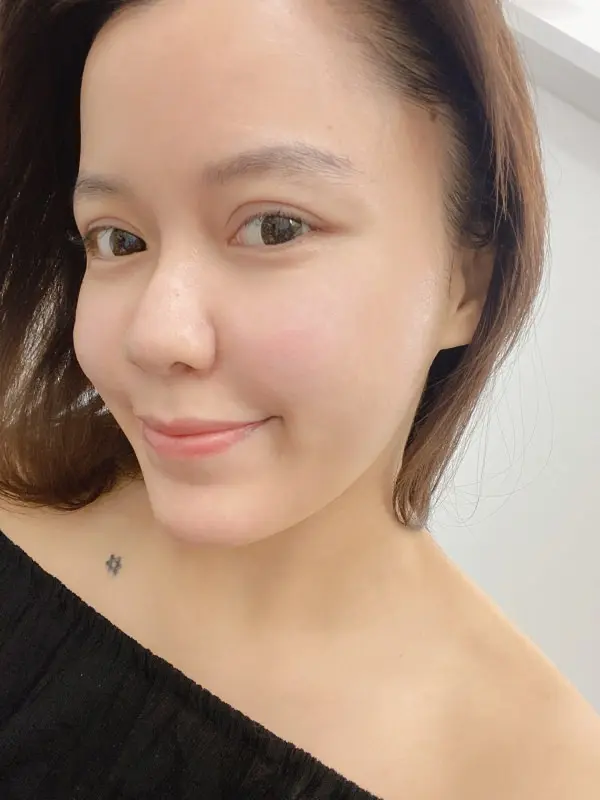 FLX鳳凰電波術後無傷口無修復期