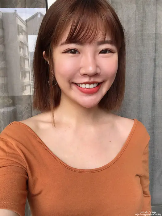玻尿酸法令紋淚溝術後