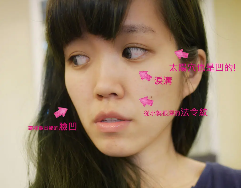 阿寧3D聚左旋乳酸治療位置