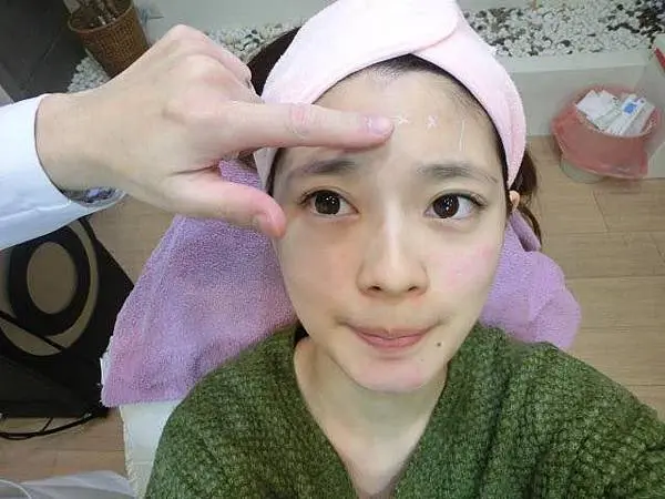 肉毒抬頭紋治療前
