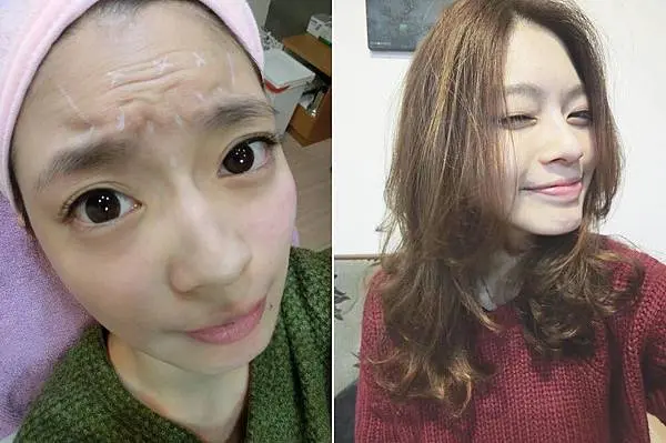 肉毒皺眉&肉毒抬頭紋治療分享