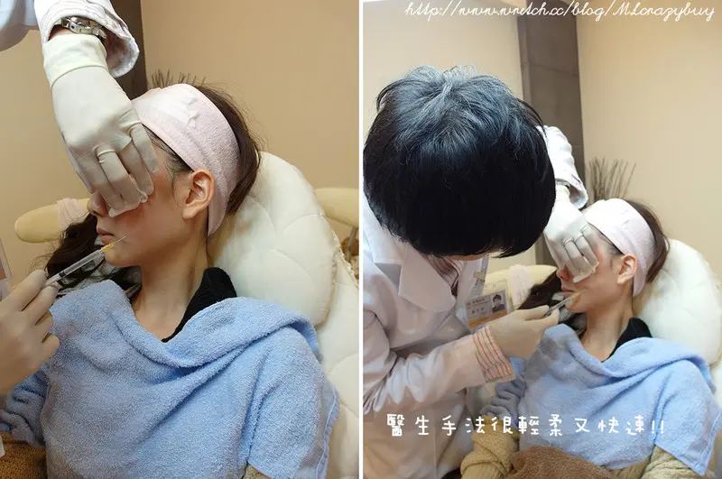 翁子軒醫師專業3D聚左旋乳酸治療法令紋