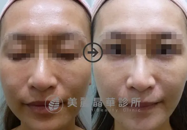德國光纖粉餅雷射改善全臉膚色不均暗沉黑肉底膚質