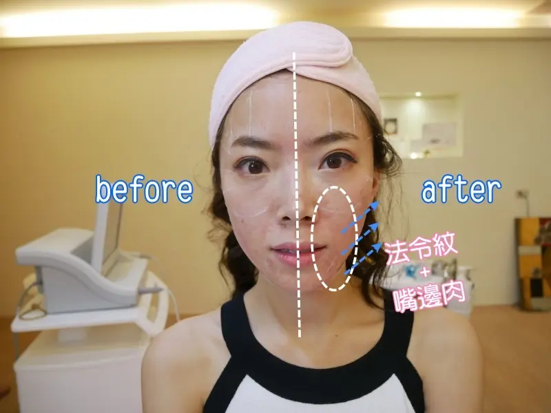 Ulthera極線音波拉提術前術後差異比較