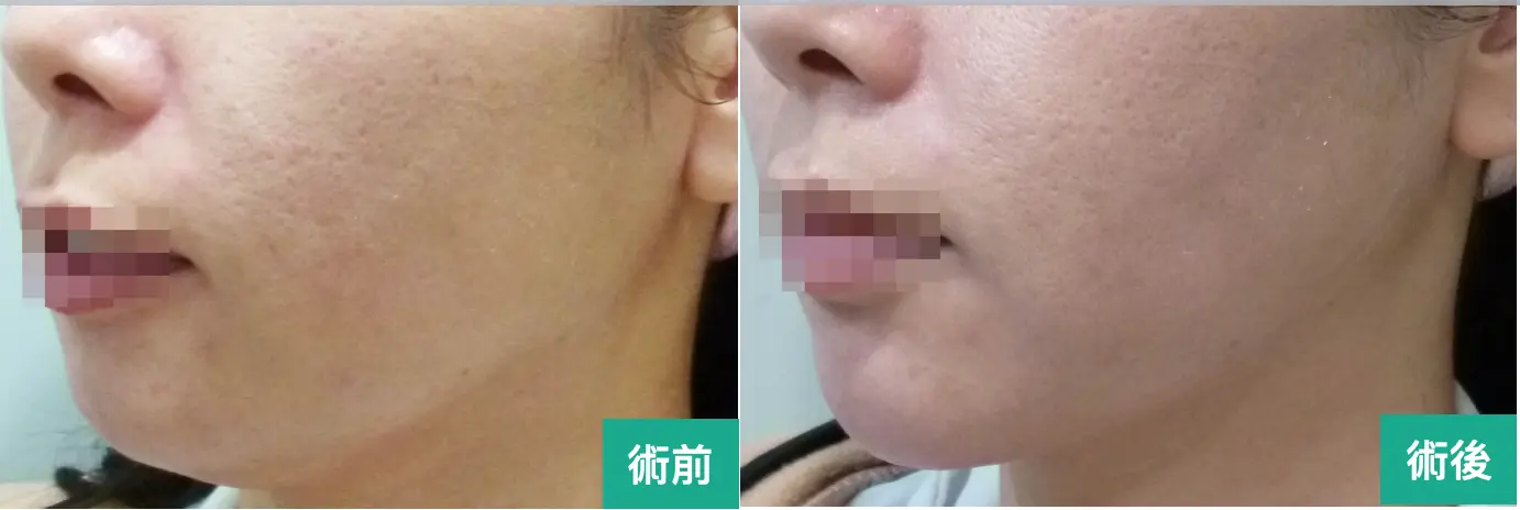 渦旋音波術前術後比較